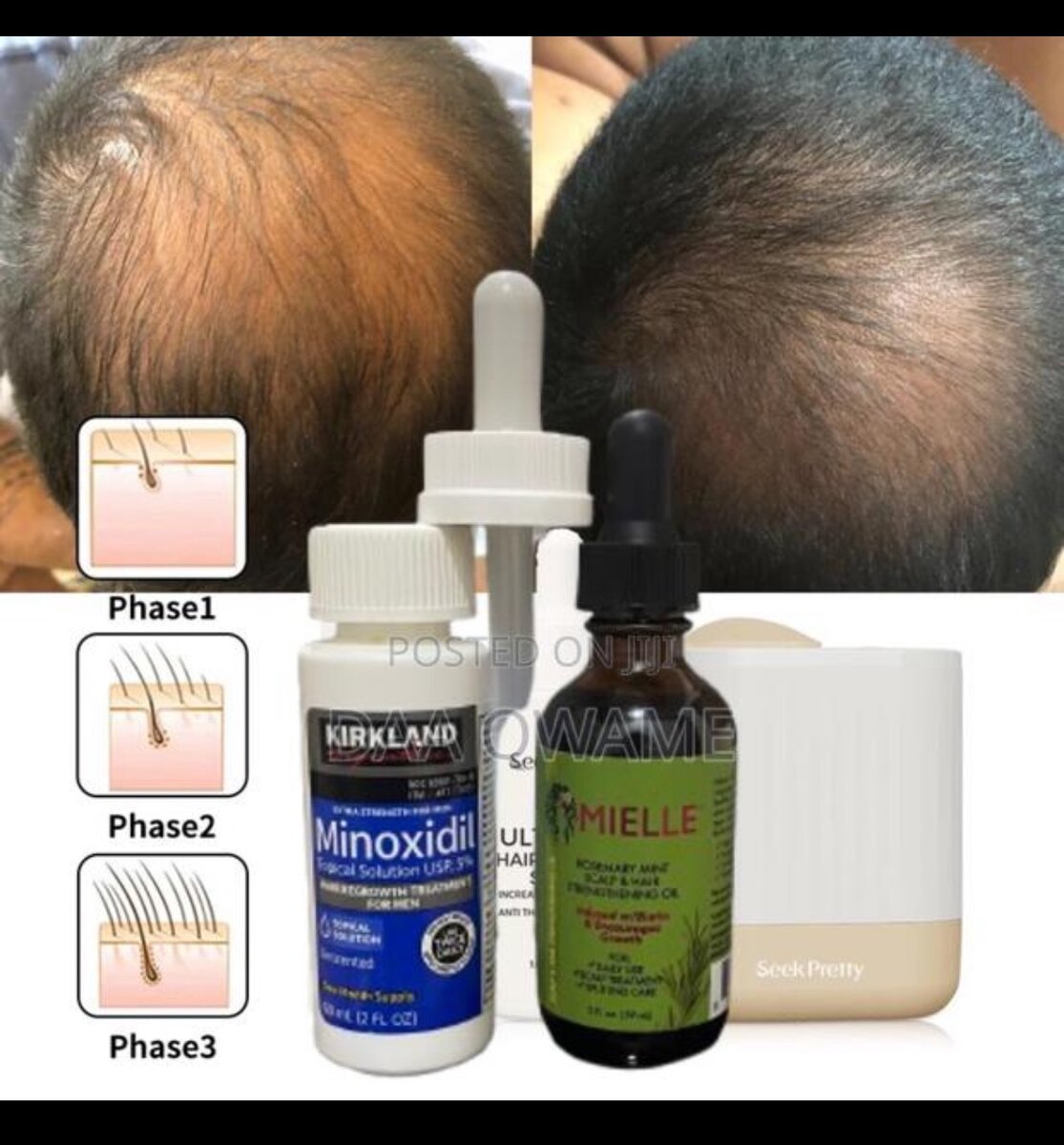 Best Super Great Combo For Hair Loss