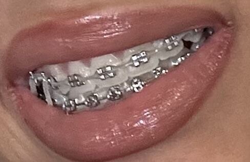 Modèle dentaire avec bagues