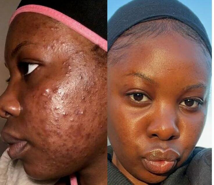 Savon visage anti-acné