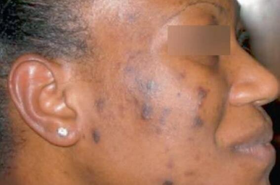 Savon de visage 3jours ko