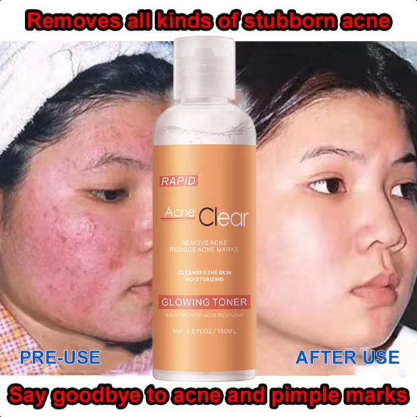 Toner Anti-Acné Rapid