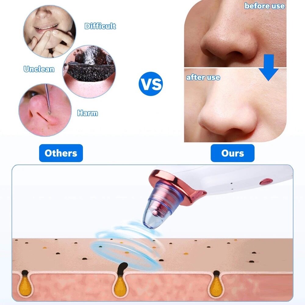 Extracteur de graisse du visage