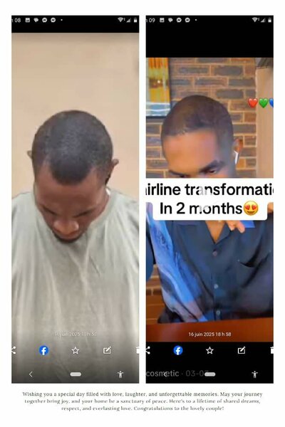 Minoxidil, repousse garantie