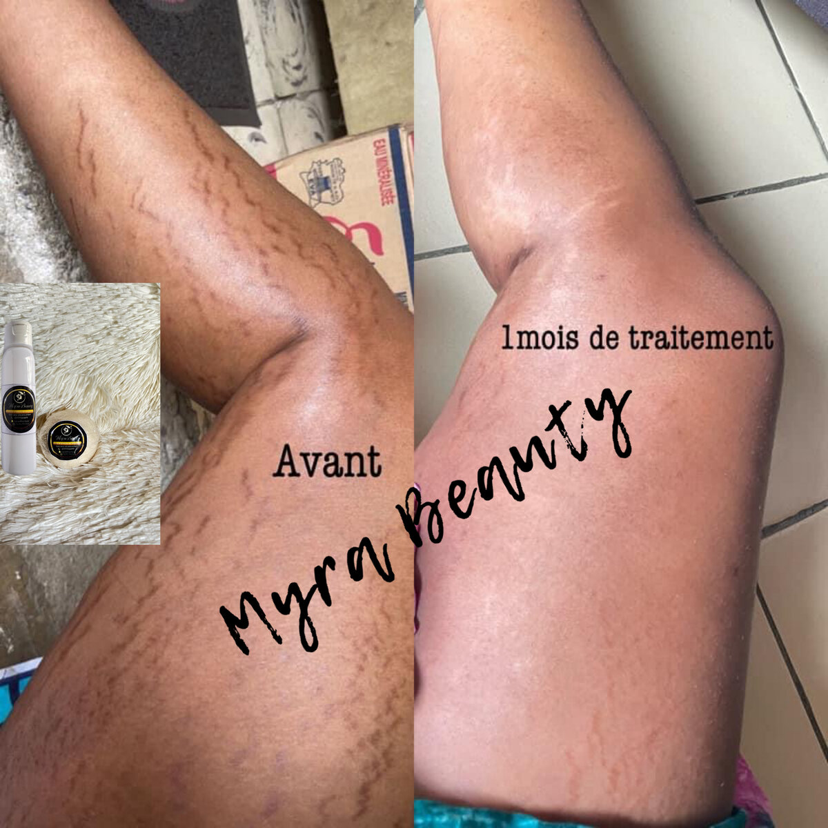 Crème Anti-Vergetures Myra