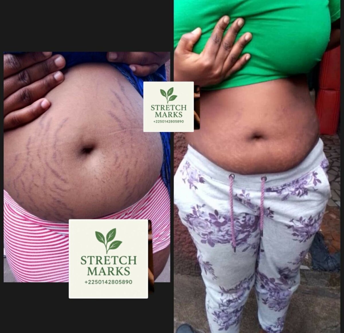 Stretch marks ( vergetures )