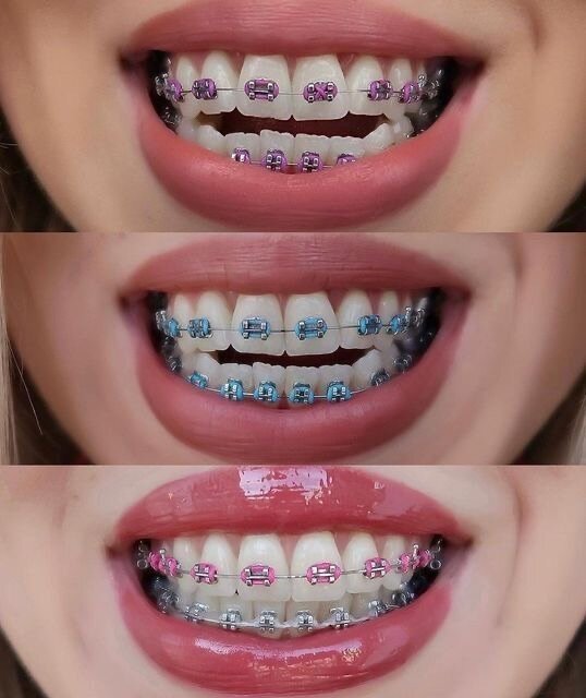 Élastiques orthodontiques colorés