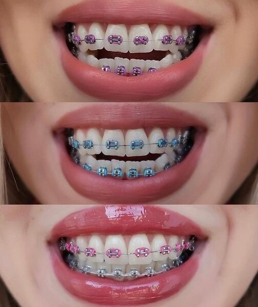 Élastiques orthodontiques colorés