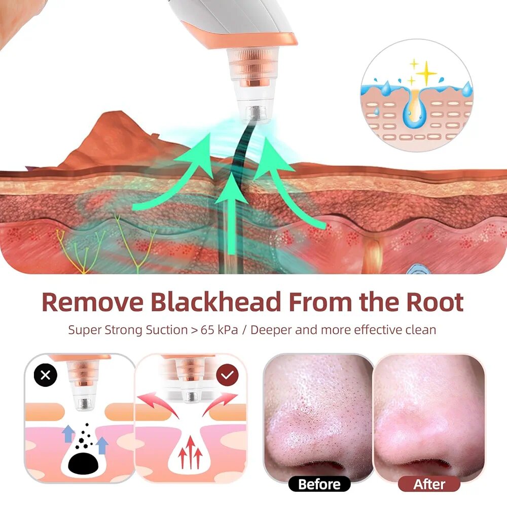 Aspirateur de Points Noirs Électrique