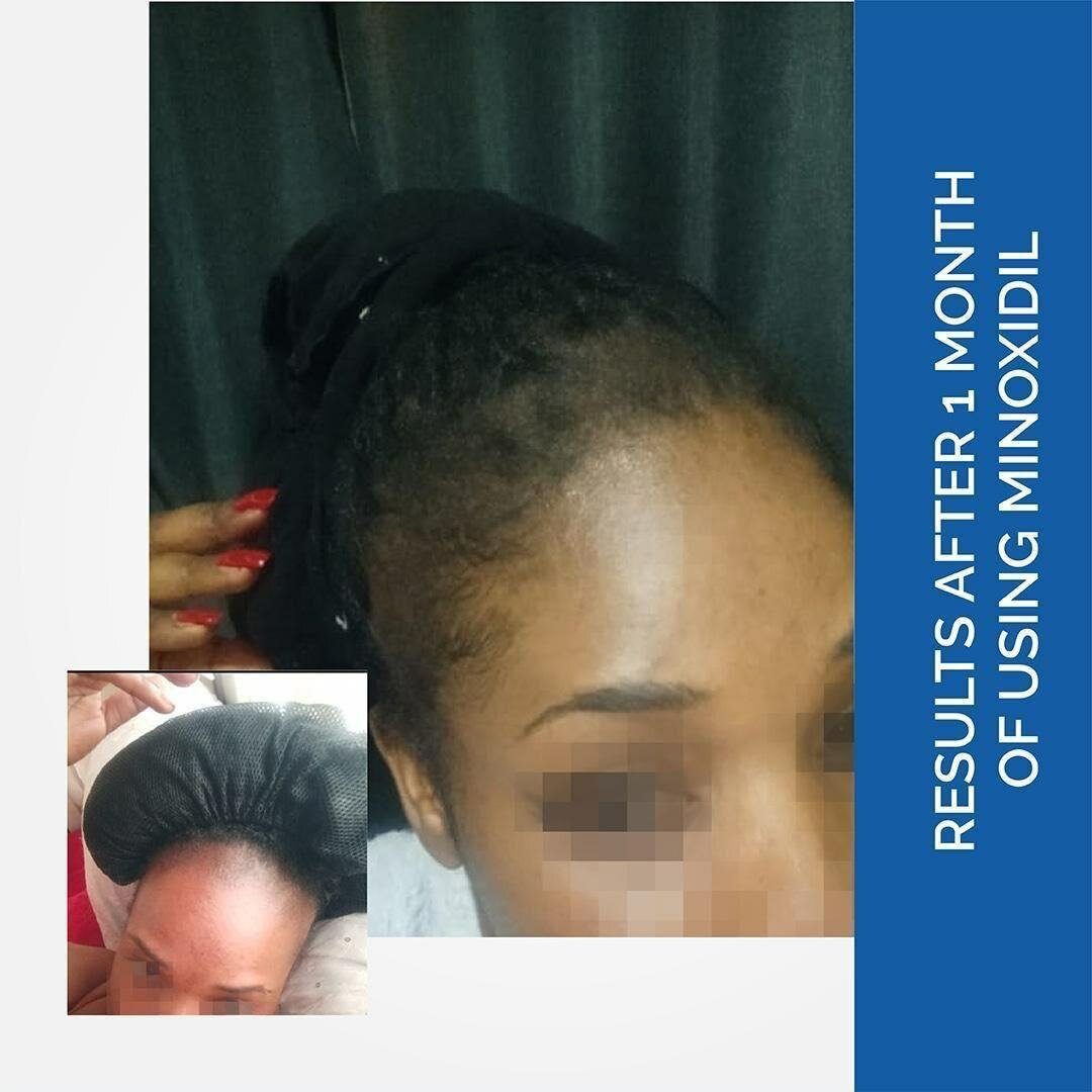 MINOXIDIL 5% (FOR MEN & WOMEN)