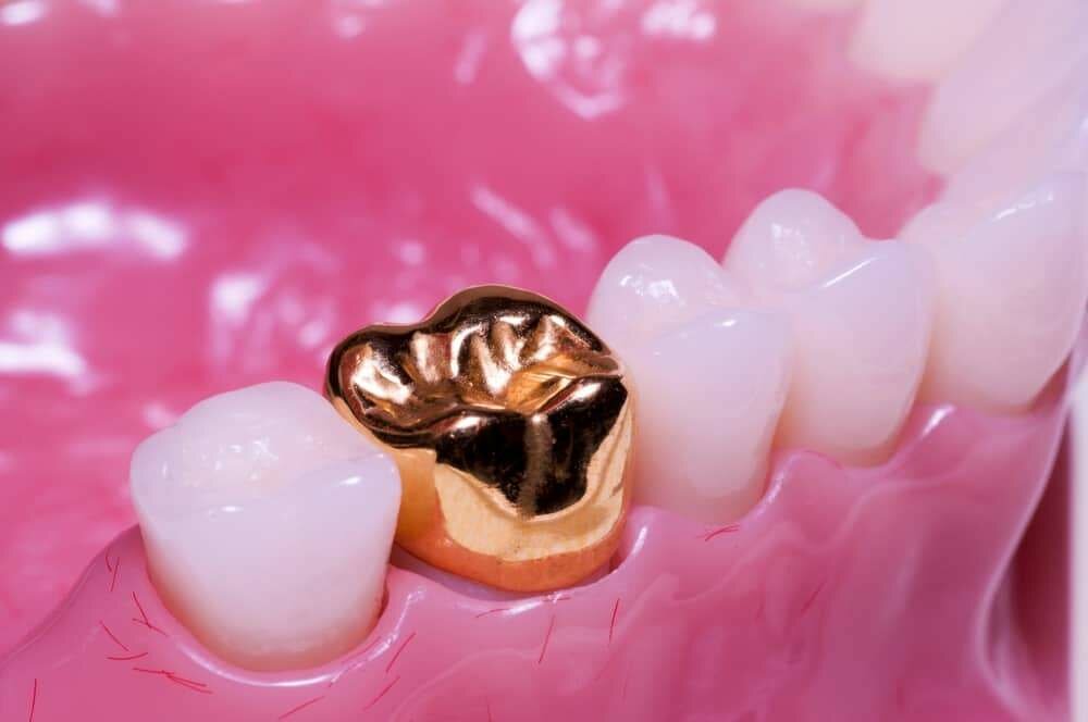 Gold tooth crown