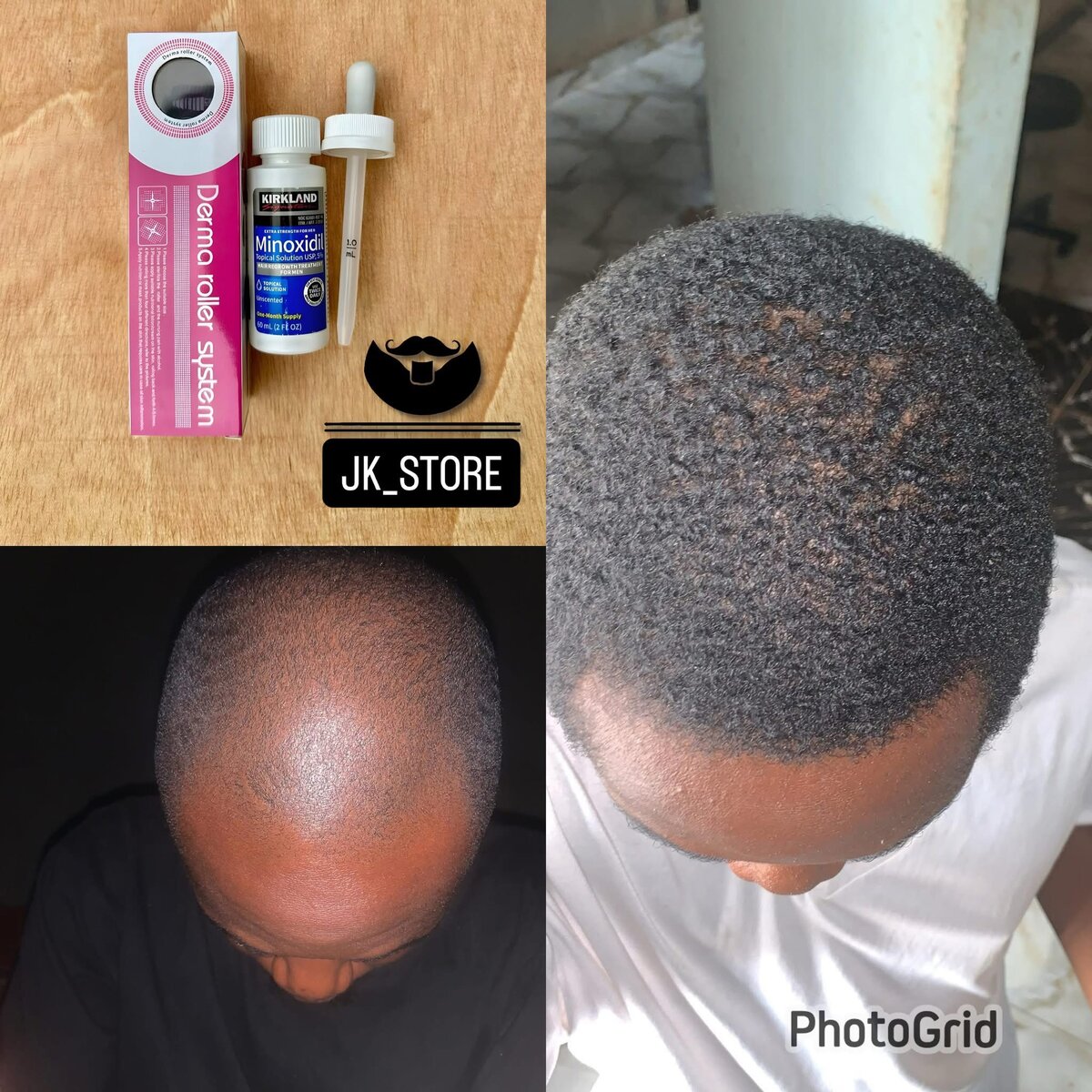 Kirkland Minoxidil 5% Hair Regrowth Treatment for Men