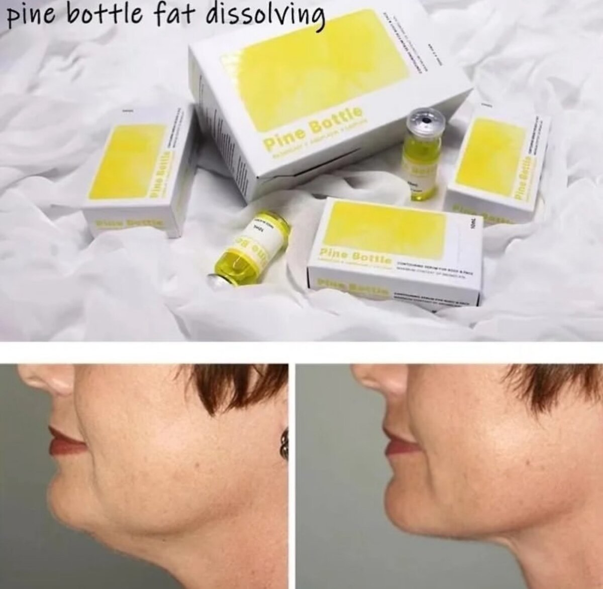 Pine bottle fat dissolving injection