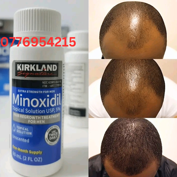 MINOXIDIL