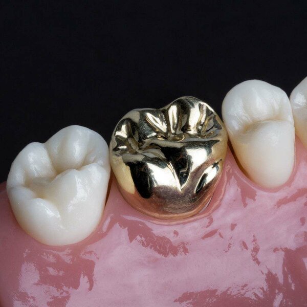 Gold tooth crown