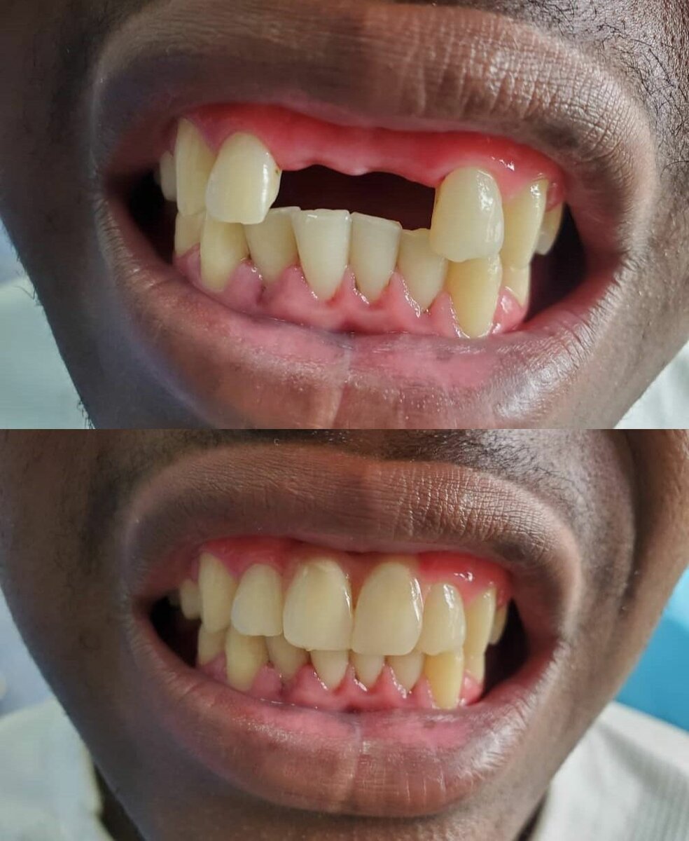 Removable dentures