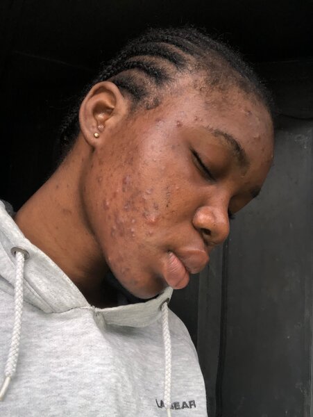 Savon noir Nigeria anti-acné