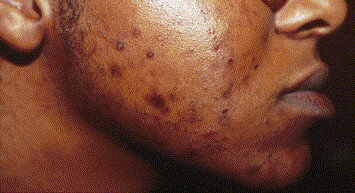 Savon de visage 3jours ko