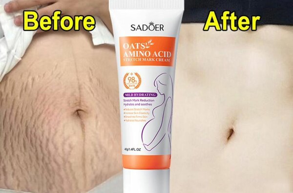 Crème Anti-Vergetures SADOER