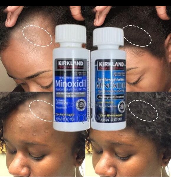 Two Kirkland Minoxidil For Hair Growth For Sale