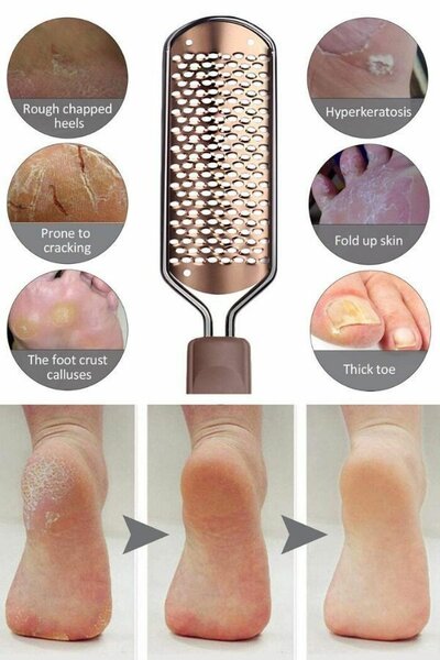 Professional Foot Callus Remover