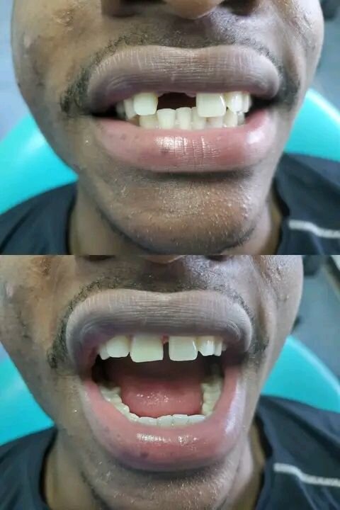Removable dentures