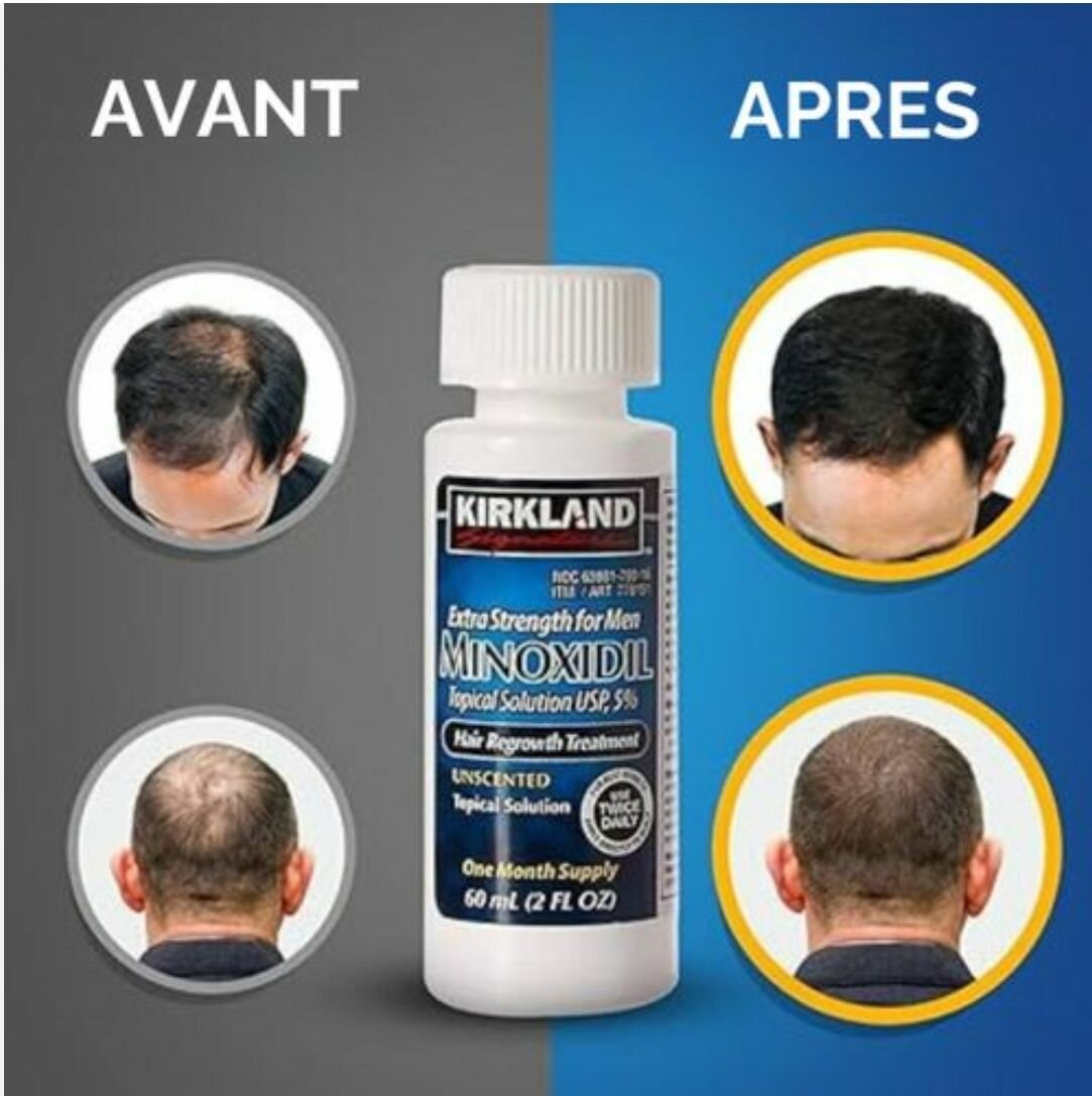 Minoxidil kirkland