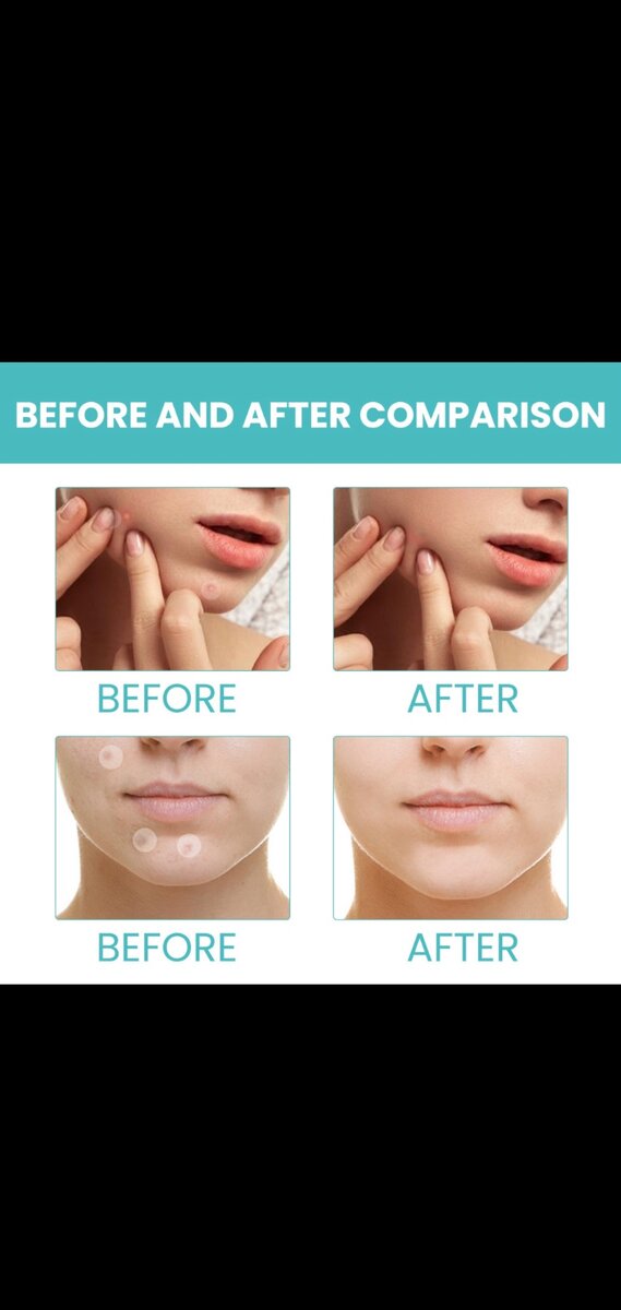 Circle pimple patches