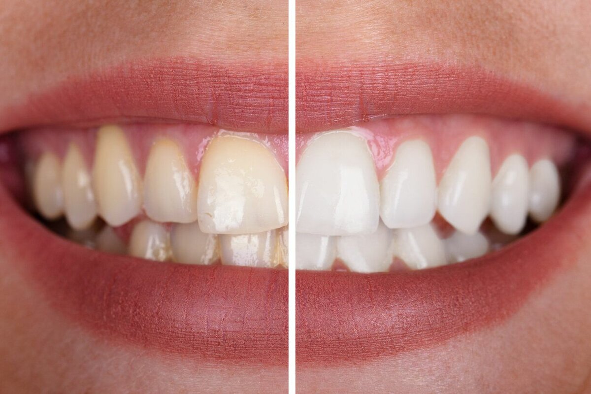 Professional teeth whitening