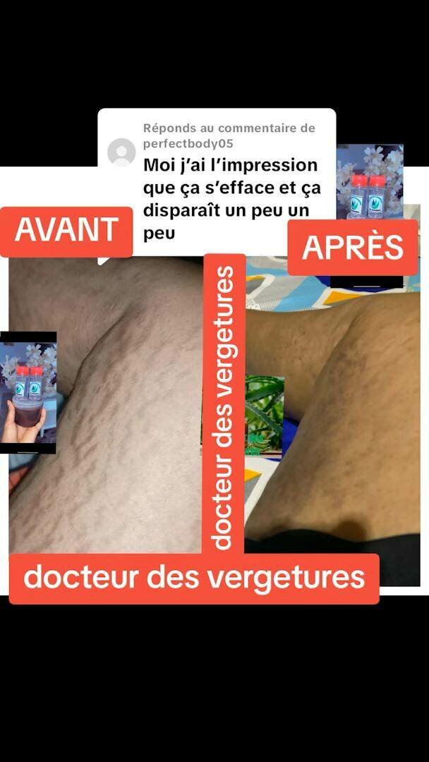 Docteur des vergetures