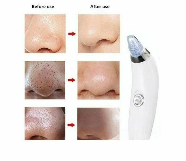 Aspirateur de graisse