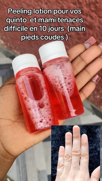 Lotion peeling anti quinto