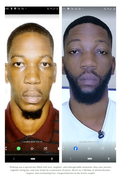 Minoxidil 5% US 🇺🇸