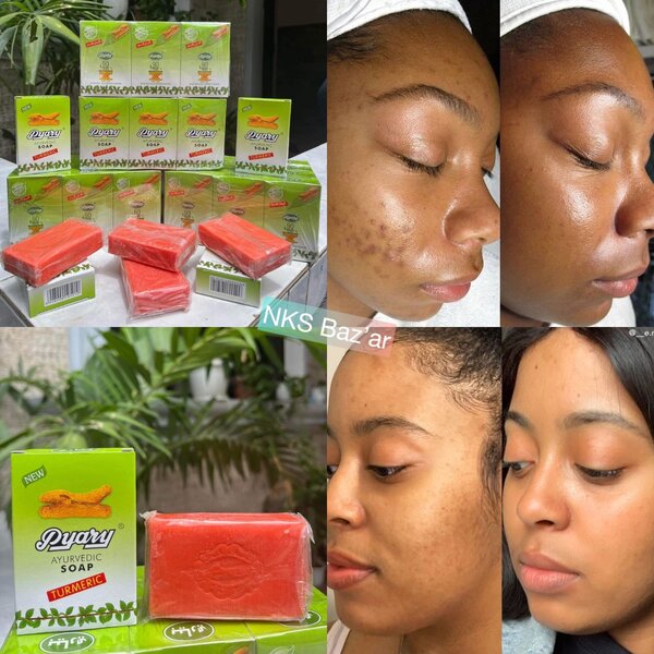 Traite le visage gras, les boutons, taches, peaux mortes