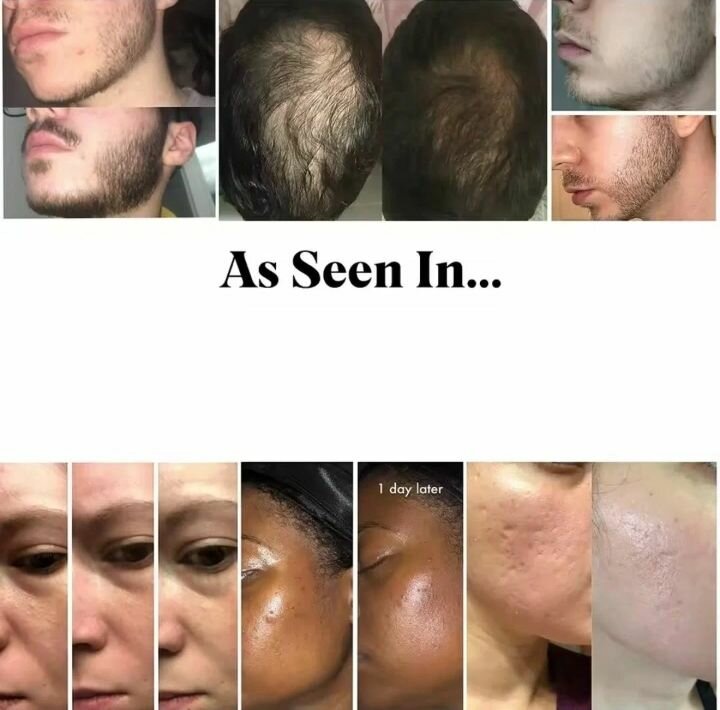 Derma Roller Système Anti-âge