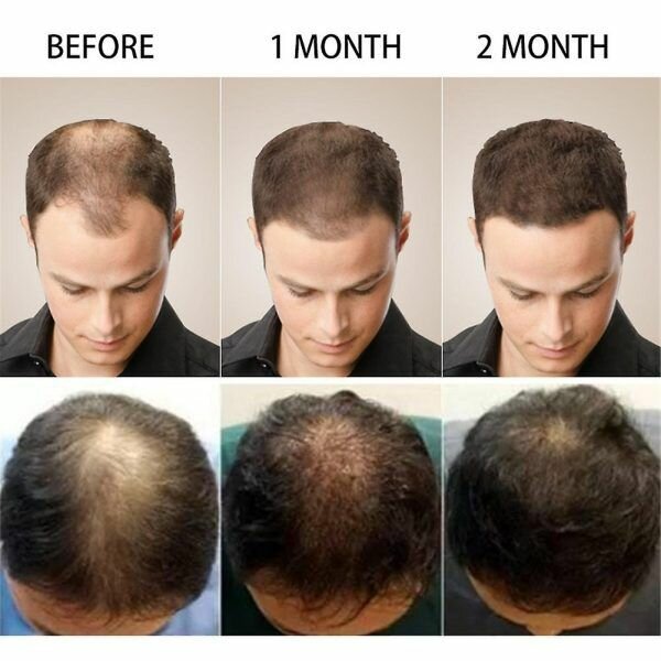 Anti hair Loss serum