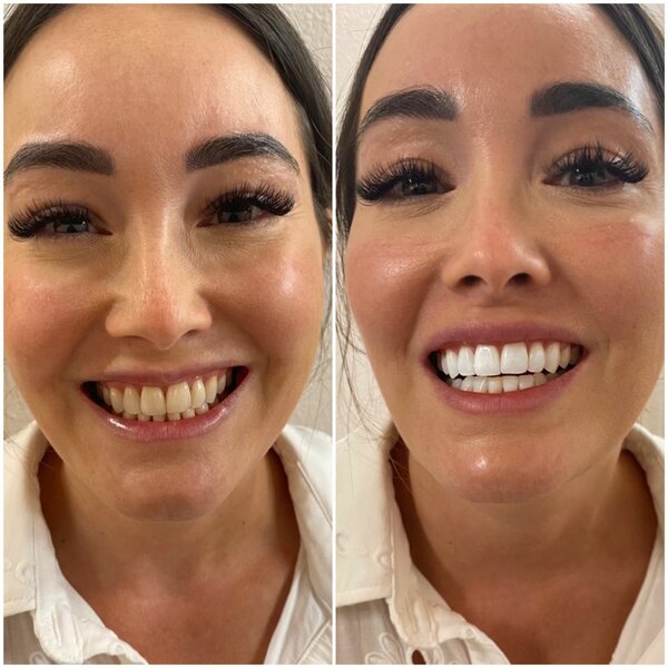 Professional teeth whitening