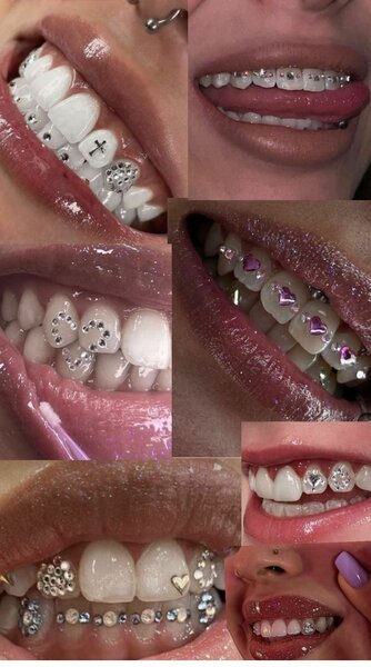 Tooth gems