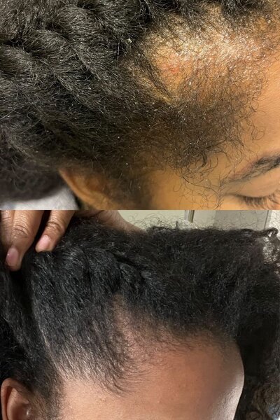 Kit Soin cheveux Derma Roller