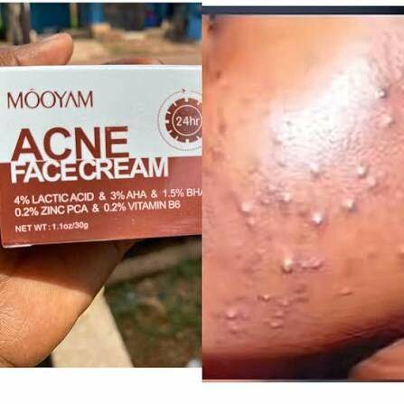 Crème Anti-Acné Efficace MOOYAM
