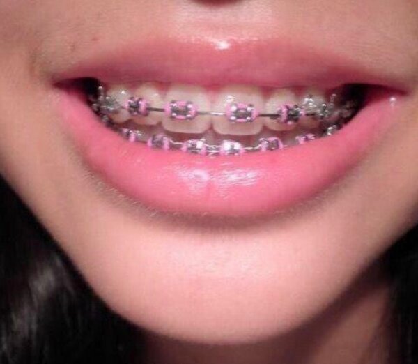 Appareils Dentaires Colorés