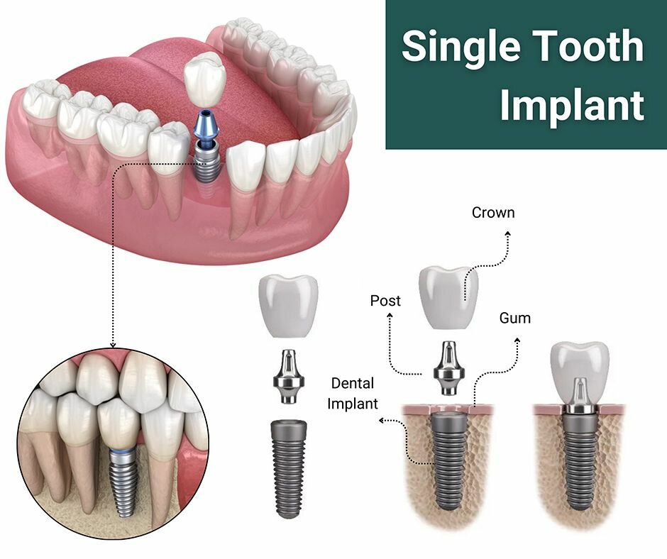 Tooth implant