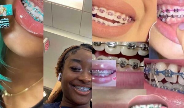 Appareils Dentaires Colorés