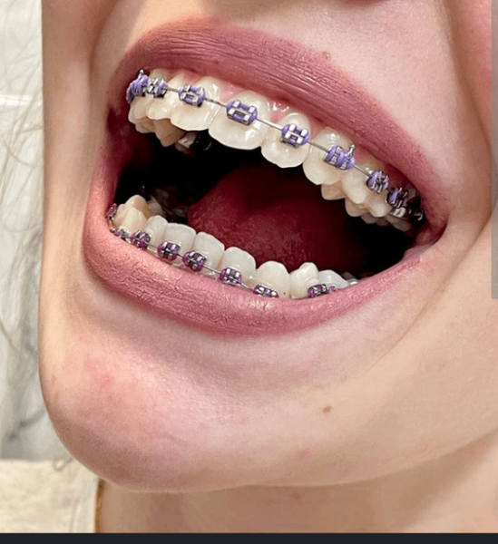 Fashion teeth braces
