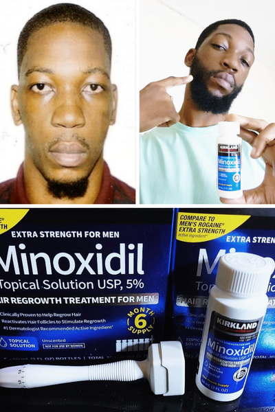 Derma stamp+ minoxidil 5%