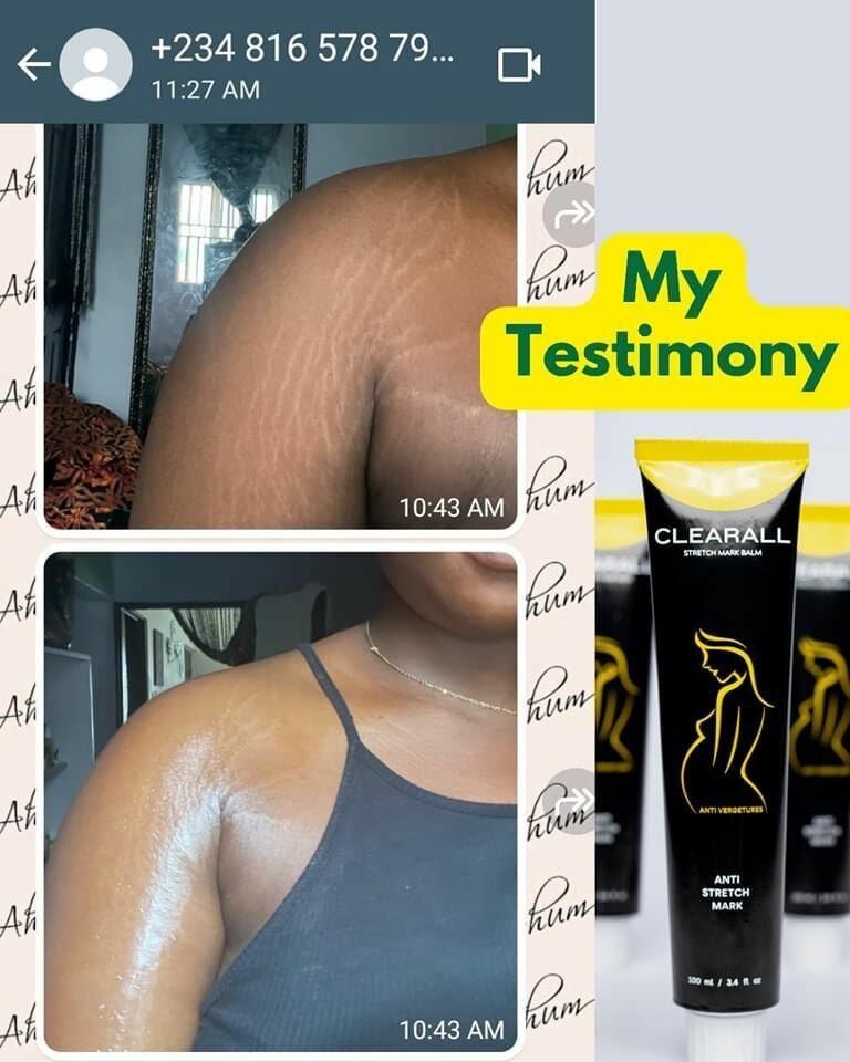 Scar and stretch Mark cream and oil