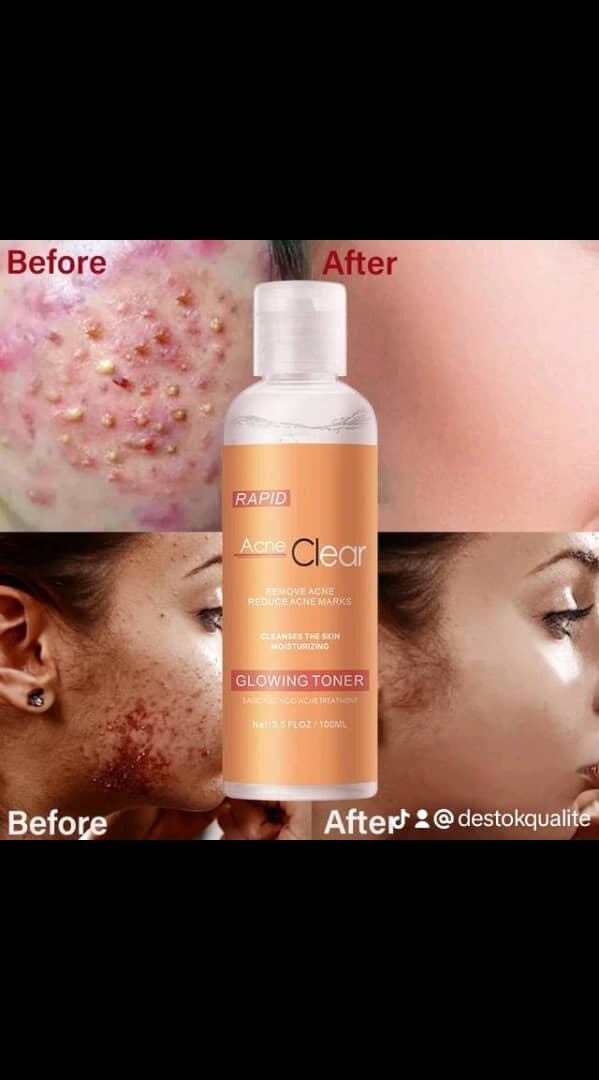 Toner Anti-Acné Éclatant