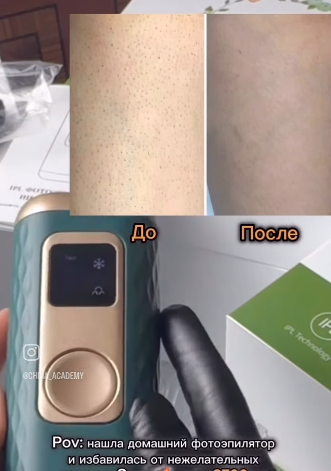 фотоэпилятор