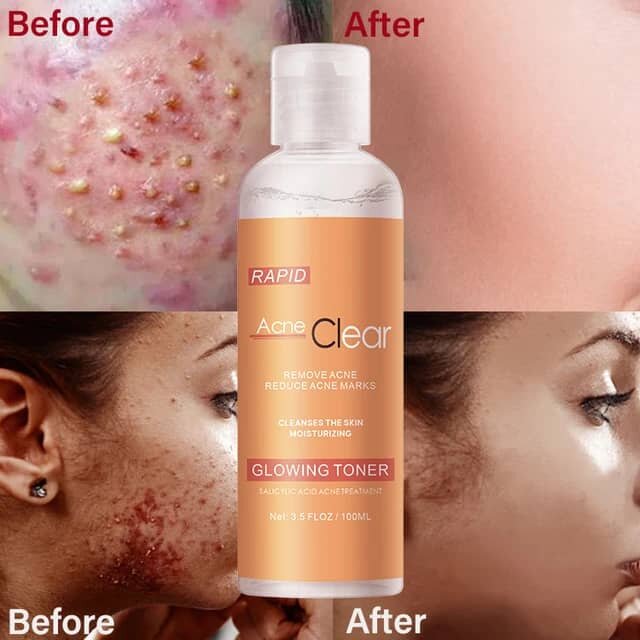 Toner Anti-Acné Éclatant