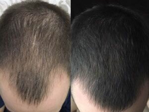 Миноксидил