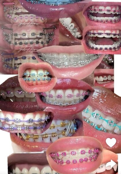 Braces